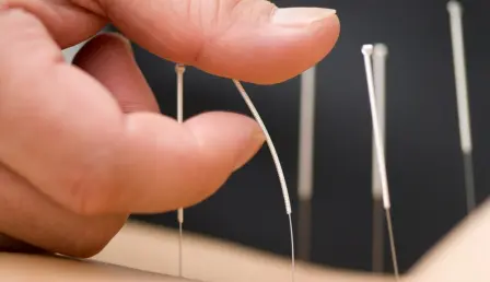 Doctor applies needles to skin for acupuncture