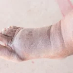 PEMFS | Healing Diabetes | Foot Ulcer | PEMFS for Diabetes