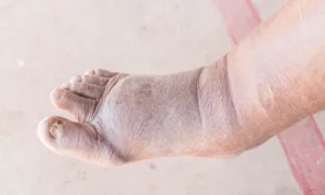 Photo of a foot with diabetic foot ulcers
