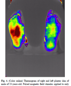 Thermogram of right and left plantar skin of male (33 years old). PEMF is only on the right foot, however it's clear there's a drastic improvement.