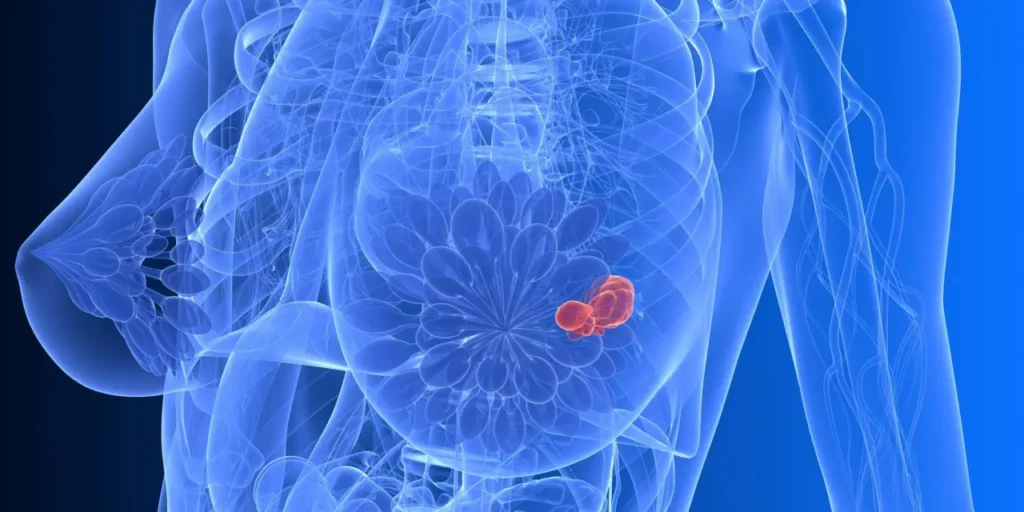 CGI of a women with breast cancer and a display of how breast cancer cells work in the breasts