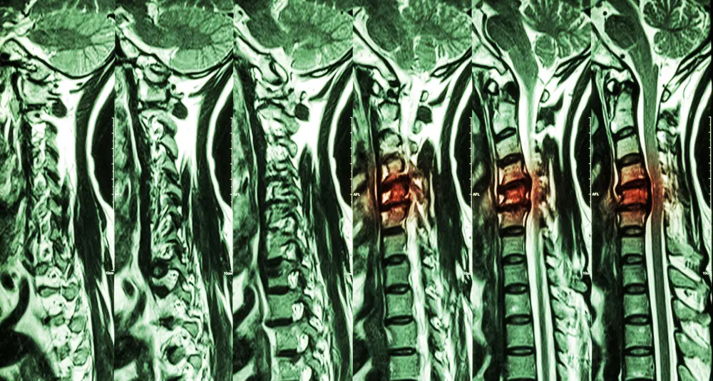 Images of a degenerative disc over time