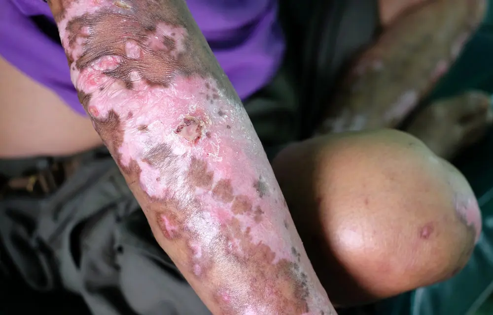 Scleroderma on arm