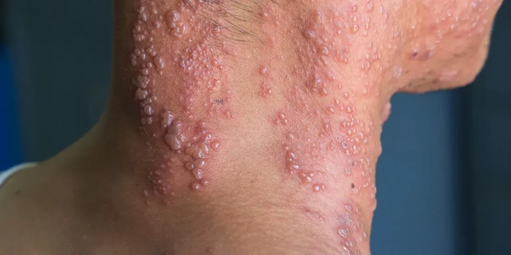 Shingles on the back of a woman's neck