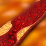 Red Blood Cells | Reduce Progression | Arteriosclerosis | Artery