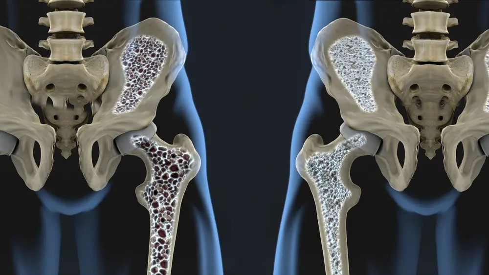 Osteoporosis | Osteopenia | Benefits | PEMFS