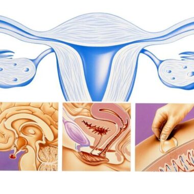 Scleroderma