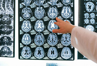 Alzheimer’s Disease